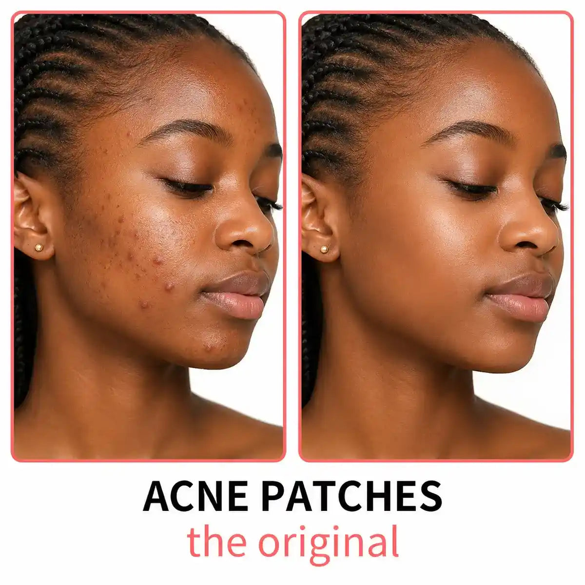 ClearDot Night Acne Patches — packaging and patches close-up